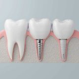 Elegir un implante dental no es una lotería, sino una decisión estratégica que debe analizarse cuidadosamente. Pero, ¿cómo elegir el mejor?