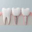 Elegir un implante dental no es una lotería, sino una decisión estratégica que debe analizarse cuidadosamente. Pero, ¿cómo elegir el mejor?