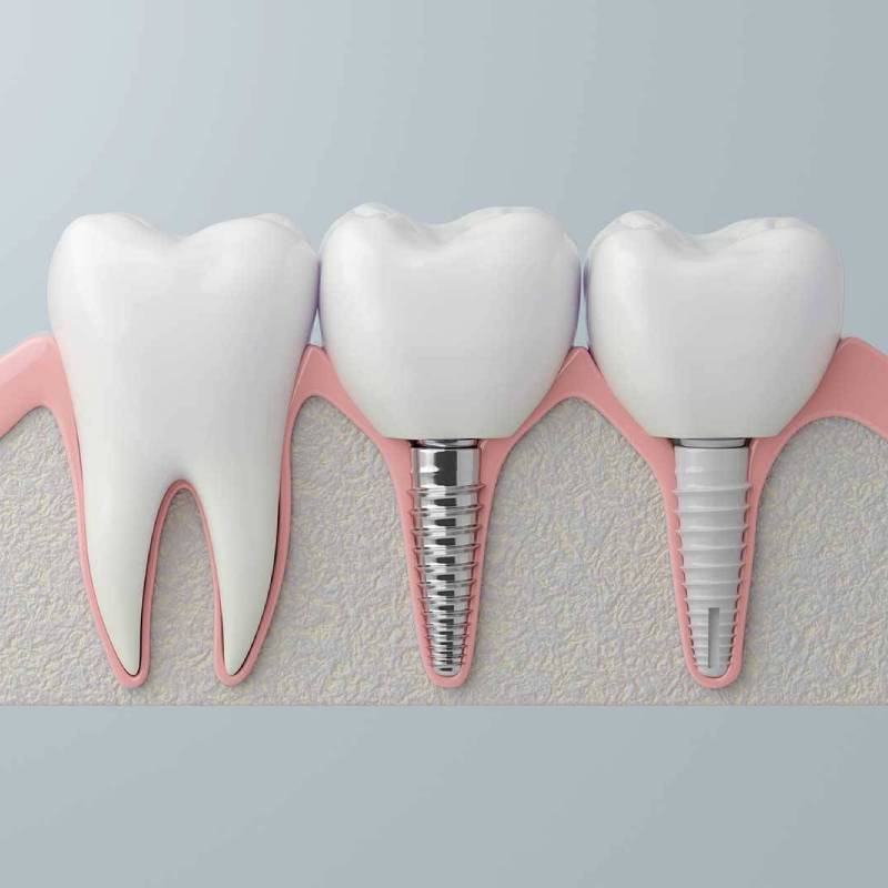 Elegir un implante dental no es una lotería, sino una decisión estratégica que debe analizarse cuidadosamente. Pero, ¿cómo elegir el mejor?